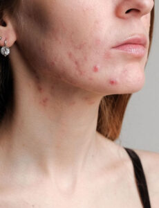 BEST SERUM FOR Acne and Blemishes Hormonal-Acne-–-Causes-Treatment-Prevention