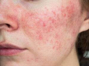 BEST SERUM FOR Sensitive Skin acne-skin-1