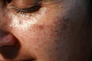 BEST SERUM FOR Dull Skin dull-skin-1