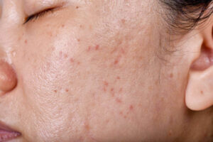 best serum for oily skin oily skin